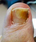 Vicks+vapor+rub+toenail+fungus