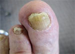 Vicks+vapor+rub+for+toenail+fungus